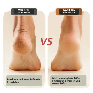 CallusElimination™ | Soft and light feet